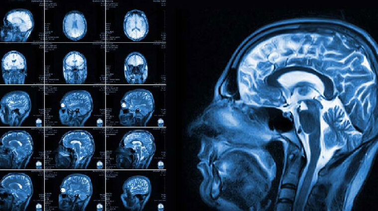 У Канаді виявили невідому хворобу головного мозку: ось її симптоми