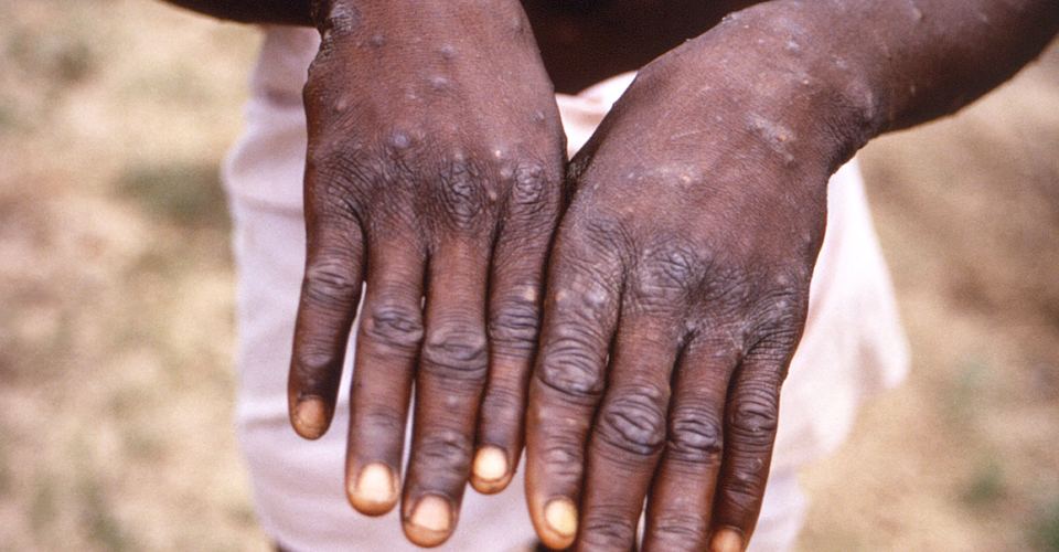 В Нигерии зафиксировали первую смерть от обезьяньей оспы