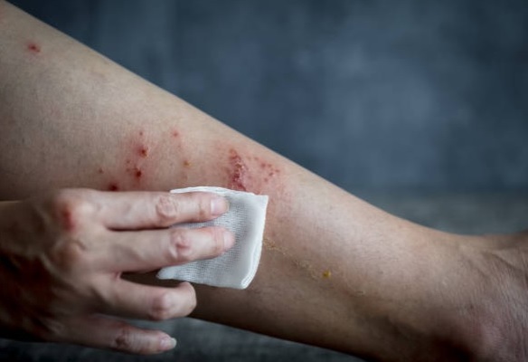 Уже 167 случаев: в Нидерландах зафиксировали обезьянью оспу