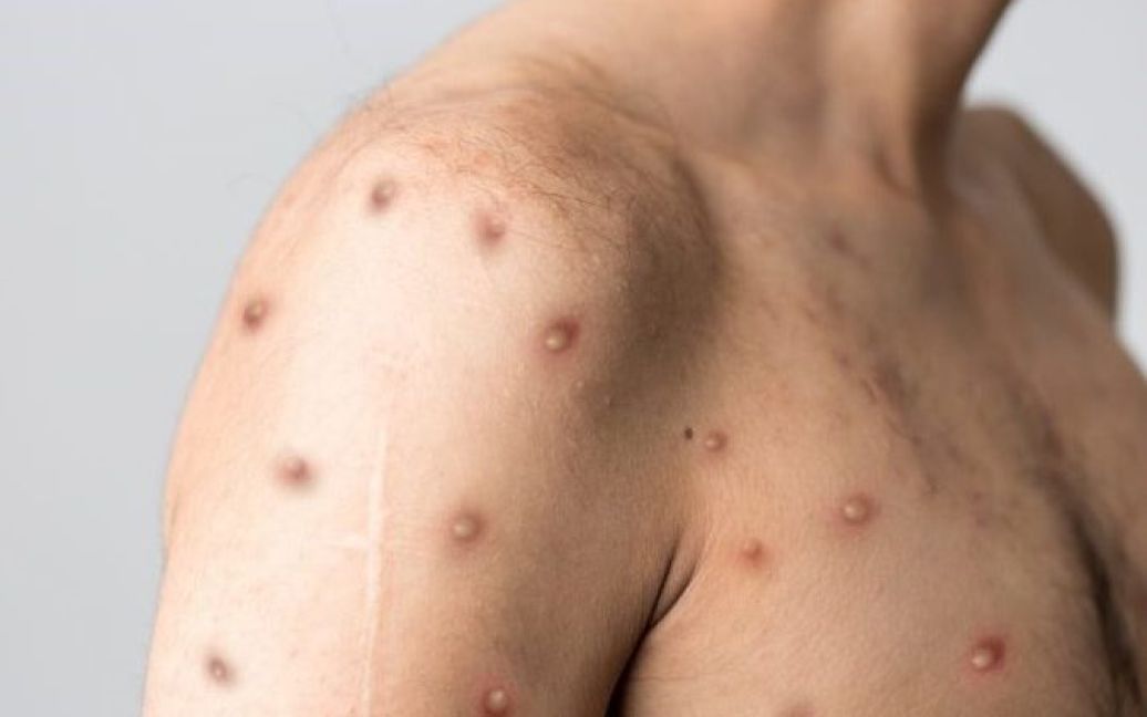 Третій випадок віспи мавп зафіксовано в Україні