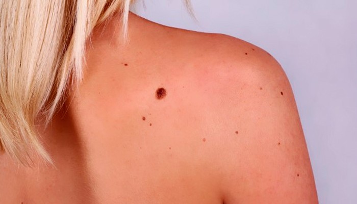 Що потрібно знати про меланому та як її діагностувати