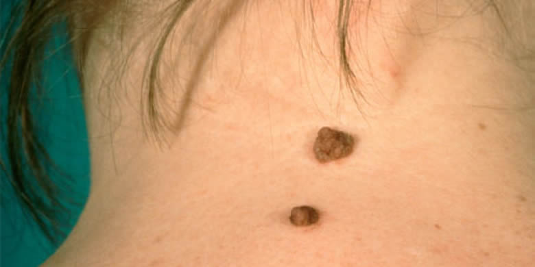 Що таке вірус папіломи людини і чим він небезпечний