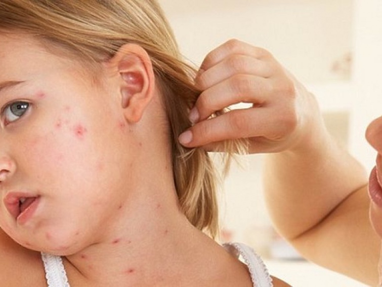 Вакцинація важлива: в Україні зареєстровані два випадки кору у дітей