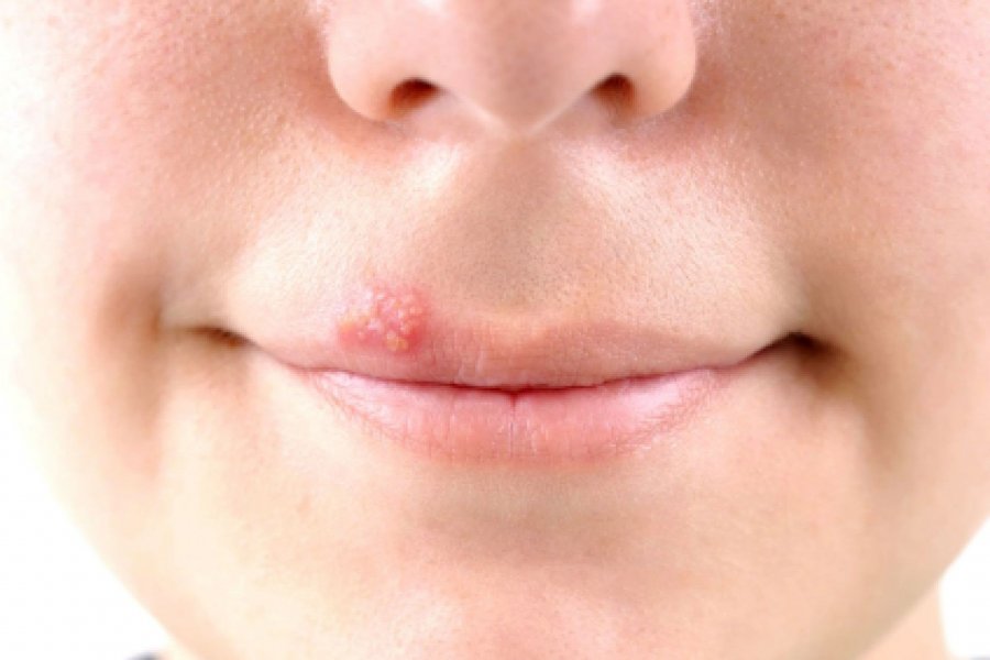 Герпес: все, що потрібно знати про поширене вірусне захворювання