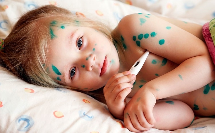 Вітрянка: як правильно лікувати "дитячу" хворобу