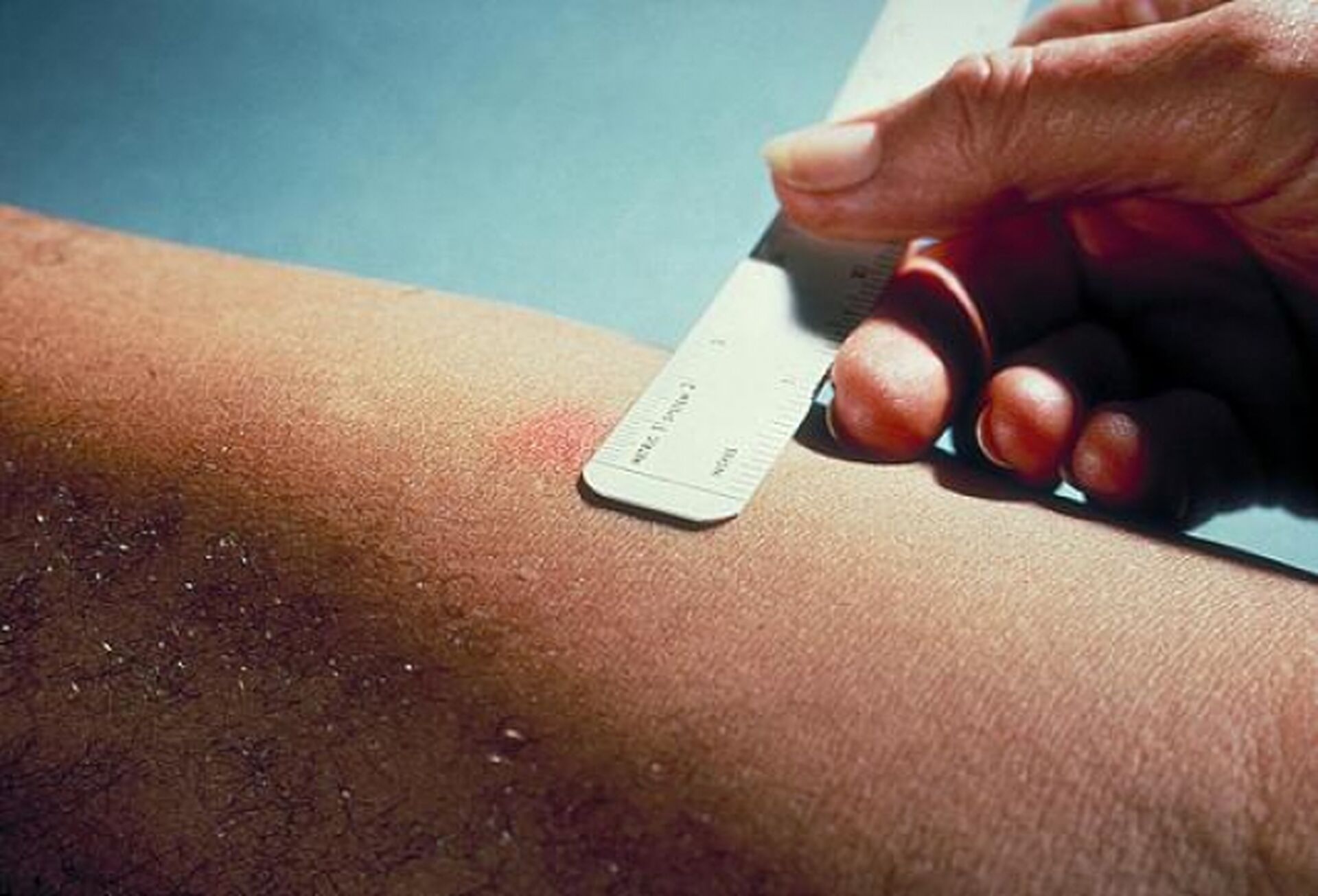 Украина отказывается от Манту: что изменится в диагностике туберкулеза